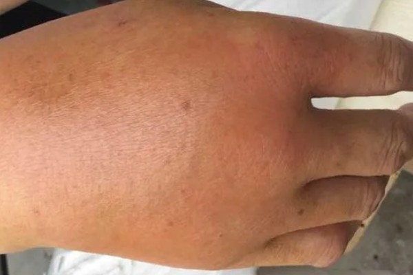 被虎头蜂蛰了疼痛持续几天,轻度蛰伤痛感会持续1-2天